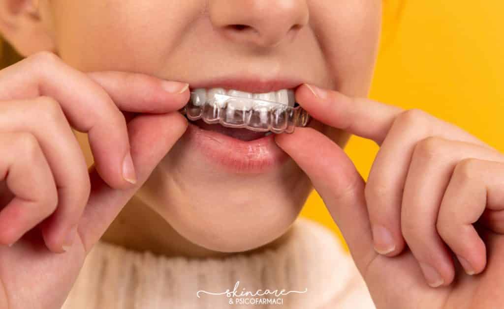 invisalign